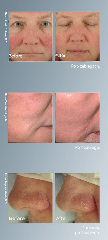 Gabinet Kosmetyczny Wrocław New Derm zabiegi laserowe