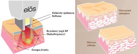 Gabinet Kosmetyczny Wrocław New Derm zabiegi laserowe